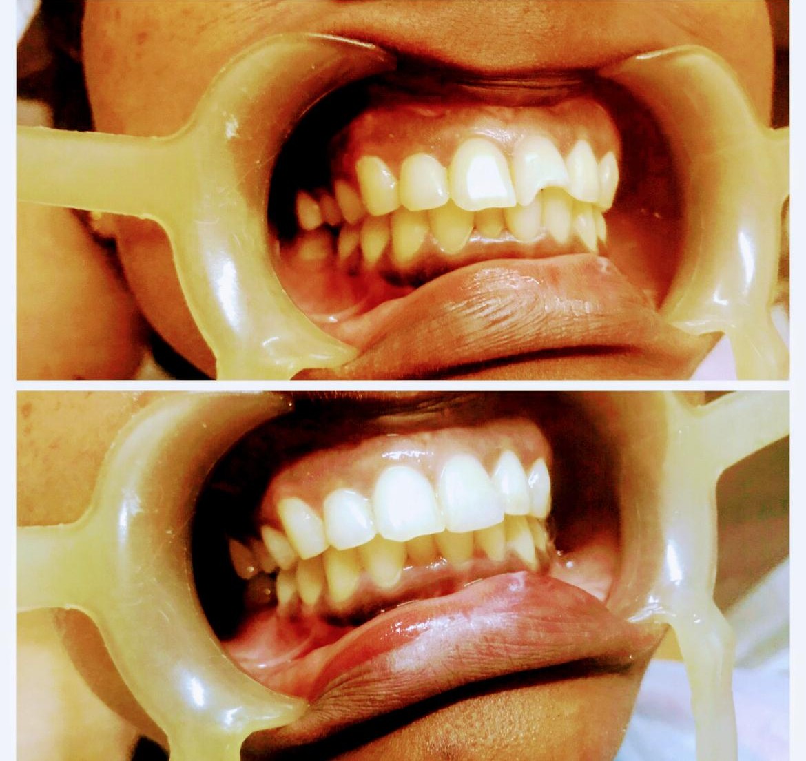 Fractured Tooth Correction